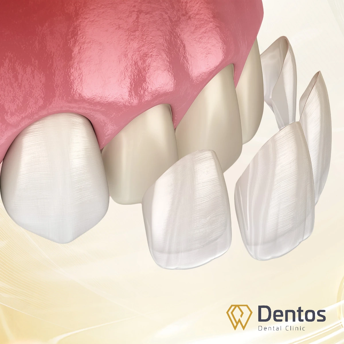 Dán sứ Veneer giúp bảo tồn tối đa cùi răng thật